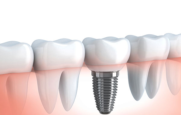 IMPLANT - GIẢI PHÁP HOÀN HẢO CHO NGƯỜI BỊ MẤT RĂNG