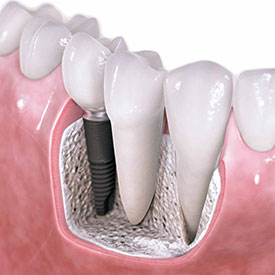 Cắm Ghép Implant