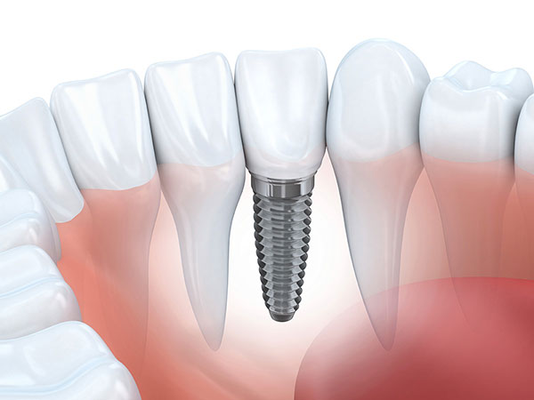 CẤY GHÉP IMPLANT CÓ ĐAU KHÔNG VÀ MẤT THỜI GIAN BAO LÂU?