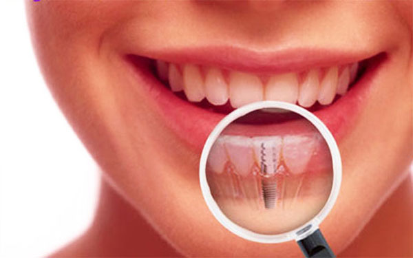 ĐIỀU TRỊ IMPLANT