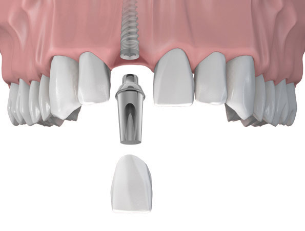 AI MẤT RĂNG CŨNG CÓ THỂ CẤY GHÉP ĐƯỢC RĂNG IMPLANT?