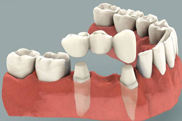 IMPLANT - GIẢI PHÁP HOÀN HẢO CHO NGƯỜI BỊ MẤT RĂNG