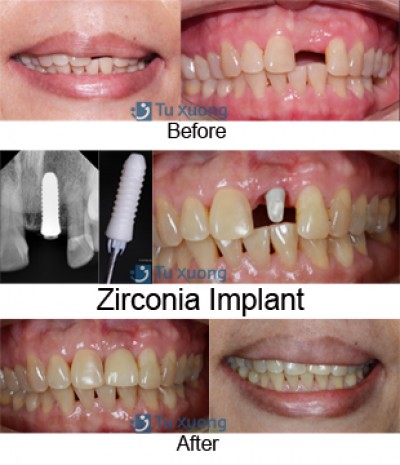 IMPLANT - GIẢI PHÁP HOÀN HẢO CHO NGƯỜI BỊ MẤT RĂNG