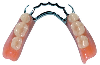 IMPLANT - GIẢI PHÁP HOÀN HẢO CHO NGƯỜI BỊ MẤT RĂNG IMPLANT - GIẢI PHÁP HOÀN HẢO CHO NGƯỜI BỊ MẤT RĂNG