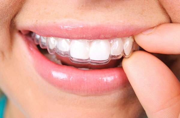 MỘT SỐ TRƯỜNG HỢP ĐIỀU TRỤ INVISALIGN THÀNH CÔNG