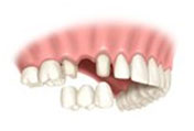 LỢI ÍCH CỦA VIỆC CẮM GHÉP IMPLANT