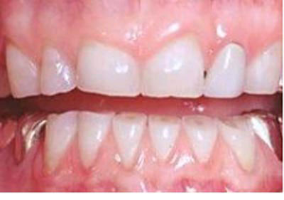 MÒN RĂNG THÔNG TIN CẦN BIẾT MÒN RĂNG THÔNG TIN CẦN BIẾT