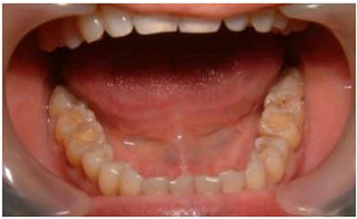 MÒN RĂNG THÔNG TIN CẦN BIẾT MÒN RĂNG THÔNG TIN CẦN BIẾT