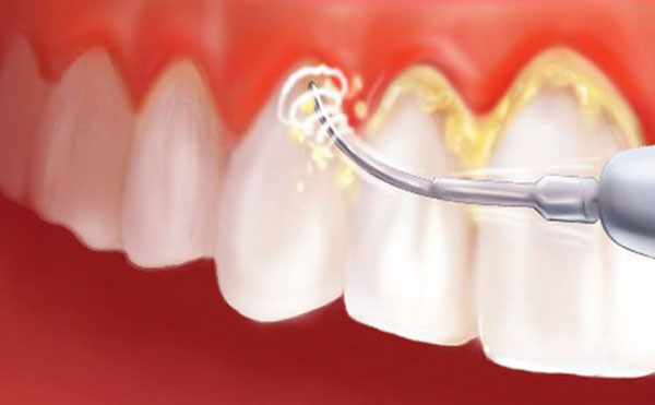 QUY TRÌNH LẤY VÔI RĂNG VÀ MẢNG BÁM QUY TRÌNH LẤY VÔI RĂNG VÀ MẢNG BÁM