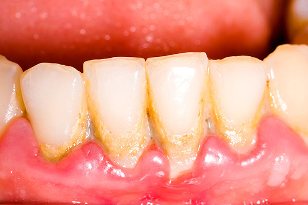 SỰ HÌNH THÀNH VÔI RĂNG VÀ MẢNG BÁM SỰ HÌNH THÀNH VÔI RĂNG VÀ MẢNG BÁM