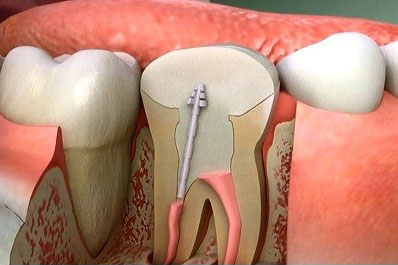 TẠI SAO PHẢI LẤY TỦY RĂNG